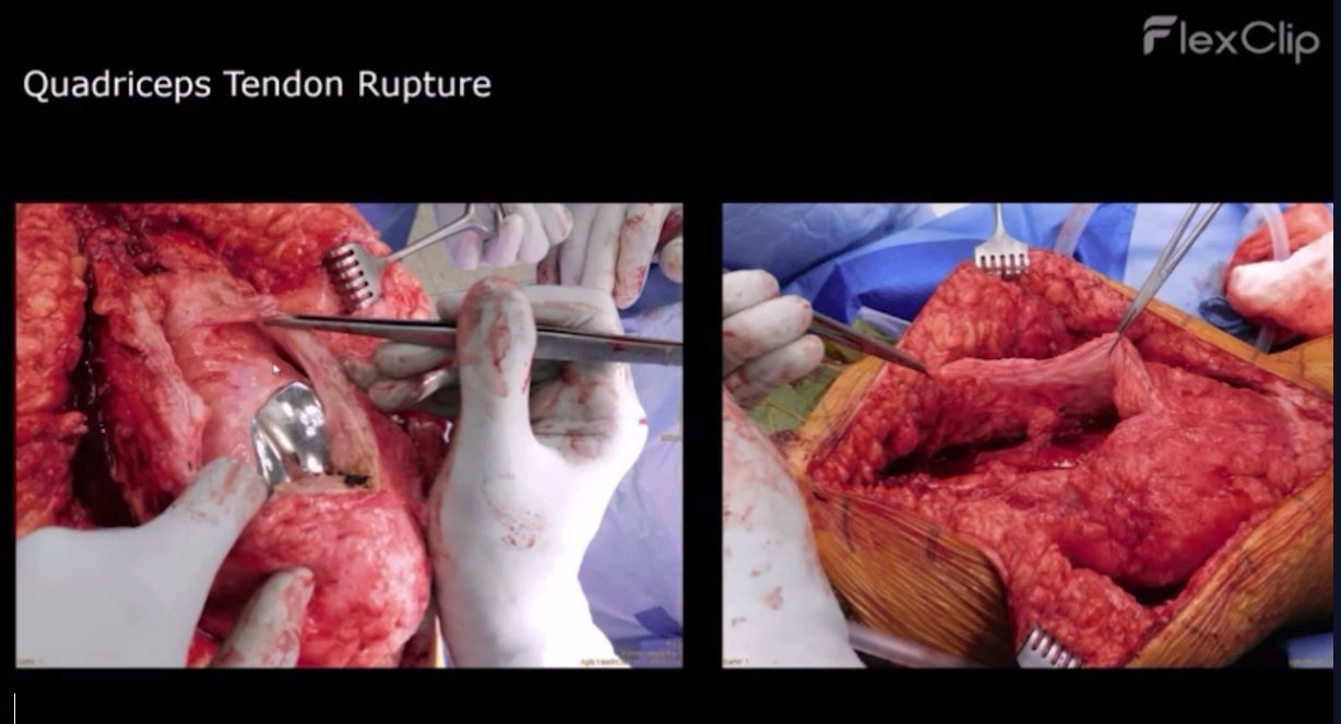 Winglet Originals #015: Revision Knee Arthroplasty – thumbnail 9 of 18