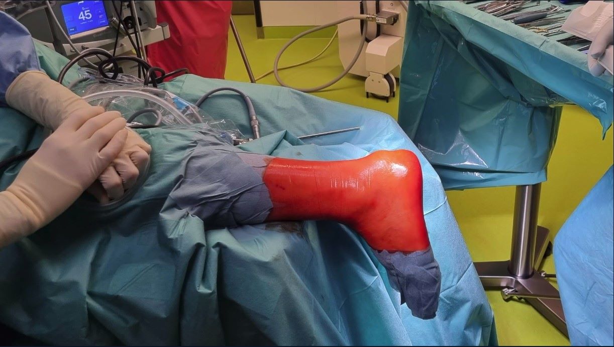 Winglet Originals #017: Degenerative Achilles Tendon Disease – thumbnail 9 of 14