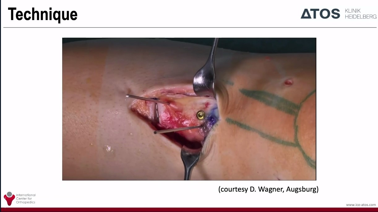 Across the Atlantic: American and European Insights on Patellar Instability – thumbnail 9 of 14