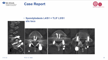 Winglet Originals #010: Disc Prolapse and Specific Back Pain – thumbnail 10 of 12