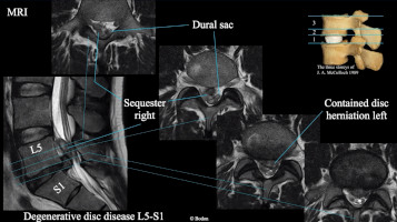 Winglet Originals #010: Disc Prolapse and Specific Back Pain – thumbnail 8 of 12