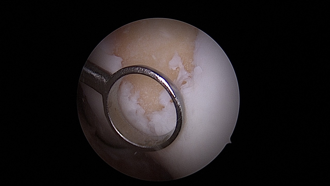 #311: Insights from the OR - Knorpelchirurgie I – thumbnail 3 of 9