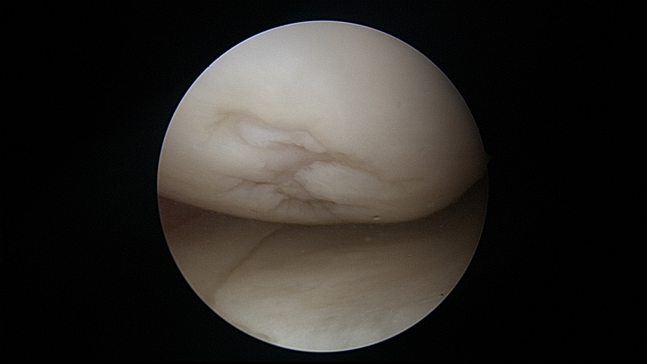 #311: Insights from the OR - Knorpelchirurgie I – thumbnail 2 of 9