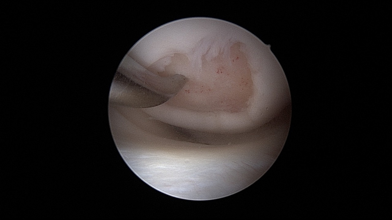 #311: Insights from the OR - Knorpelchirurgie I – thumbnail 6 of 9