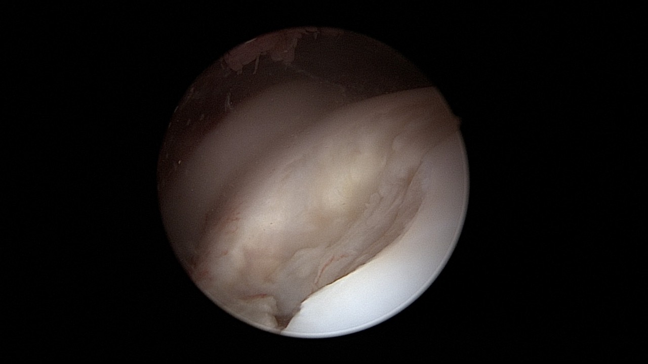 #311: Insights from the OR - Knorpelchirurgie I – thumbnail 8 of 9