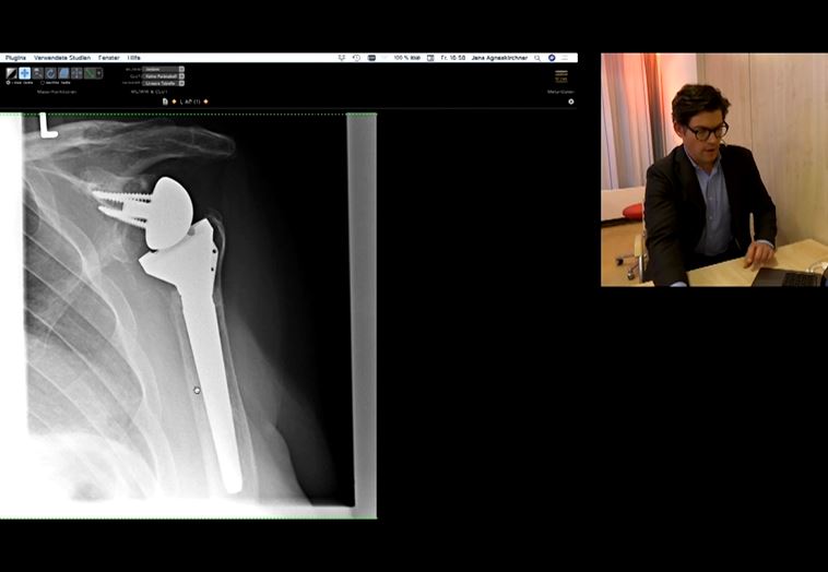 Hanover Live Surgeries - Shoulder Arthroplasty with Glenoid Bone Reconstruction – thumbnail 2 of 3