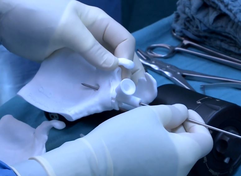 Hanover Live Surgeries - Shoulder Arthroplasty with Glenoid Bone Reconstruction – thumbnail 3 of 3