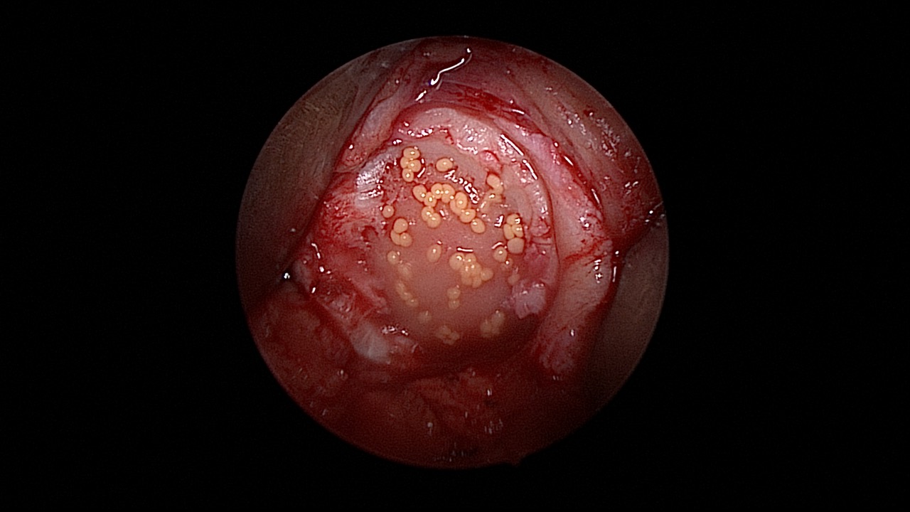 #311: Insights from the OR - Knorpelchirurgie I – thumbnail 7 of 9